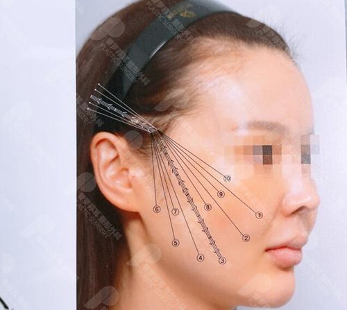 做拉皮手术后，耳朵角度发生变化正常吗？