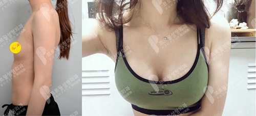 韩国profile普罗菲耳整形医院郑在皓院长假体隆胸案例