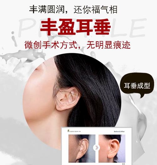 韩国profile普罗菲耳整形医院丰盈耳垂、耳垂成形术