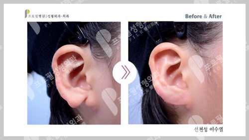 韩国profile普罗菲耳整形医院先天性耳垂裂矫正案例
