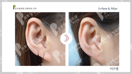 韩国profile普罗菲耳整形医院耳损伤矫正案例
