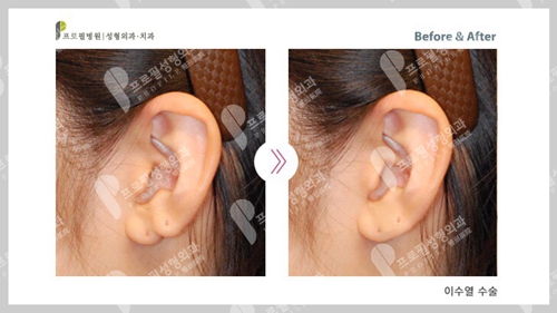 韩国profile普罗菲耳整形医院耳垂畸形矫正案例