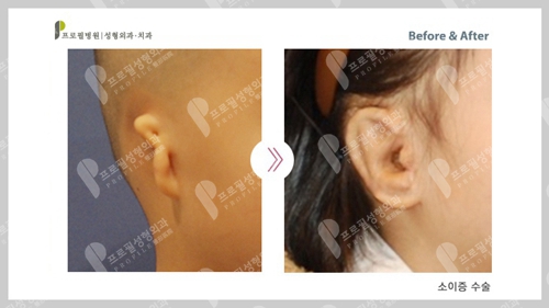 韩国普露菲耳profile整形医院耳畸形矫正案例