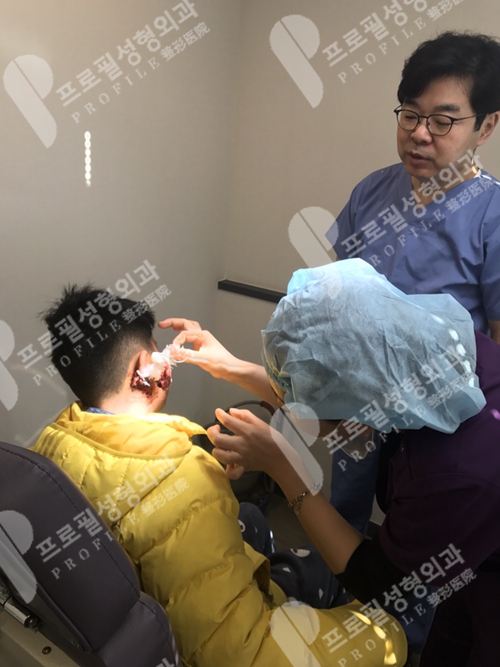 韩国profile医院耳畸形患者术后复查
