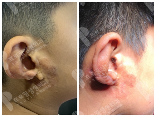 韩国profile医院耳畸形患者术前术后对比照