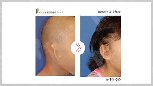 韩国profile普罗菲耳整形医院耳再造手术案例