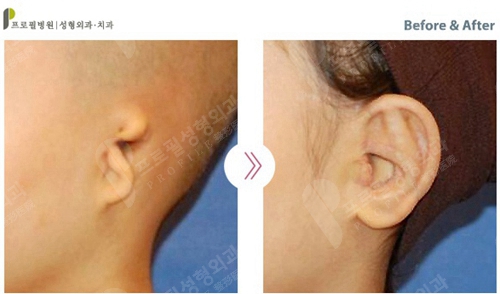 韩国profile普罗菲耳整形医院耳畸形矫正案例
