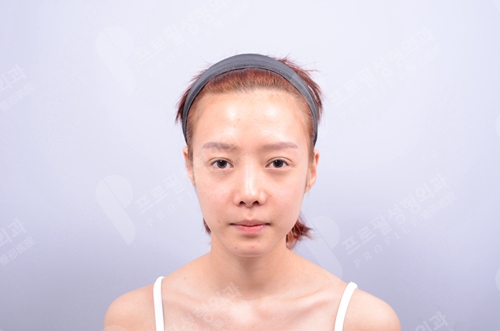 韩国profile普罗菲耳整形外科贴发耳
