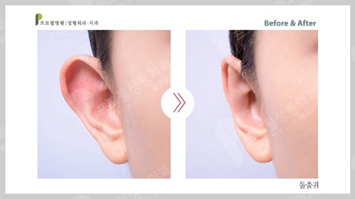 韩国profile普罗菲耳整形外科招风耳矫正手术案例