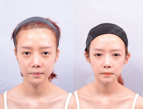 韩国profile普罗菲耳整形外科贴发耳矫正手术案例
