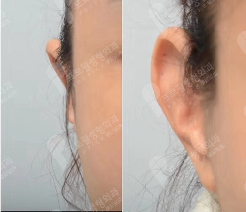 韩国profile普罗菲耳整形外科贴发耳矫正案例