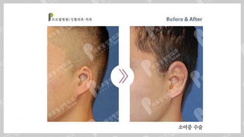 profile耳廓缺失重建手术