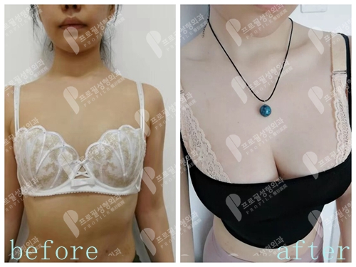 韩国普罗菲耳隆胸模特