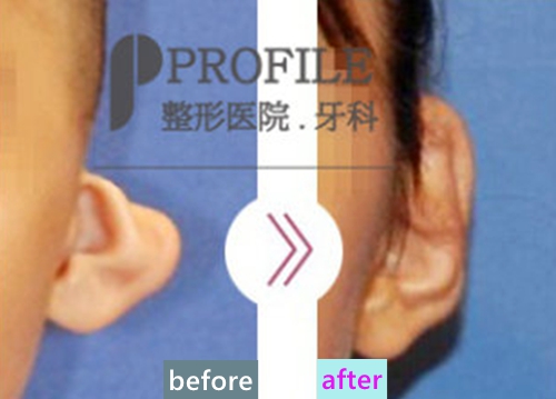 韩国profile普罗菲耳医院耳畸形矫正案例