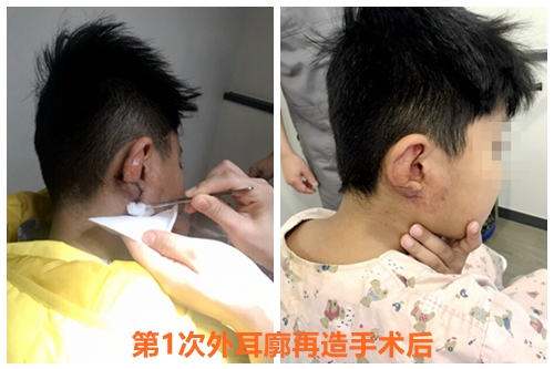 韩国Profile普罗菲耳医院外耳廓再造术后康复护理
