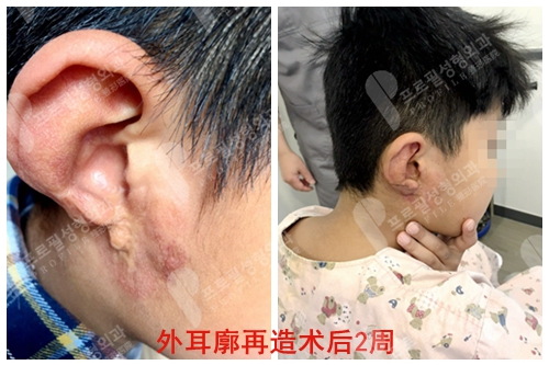 韩国profile普罗菲耳医院外耳廓再造术后2周恢复前后对比图