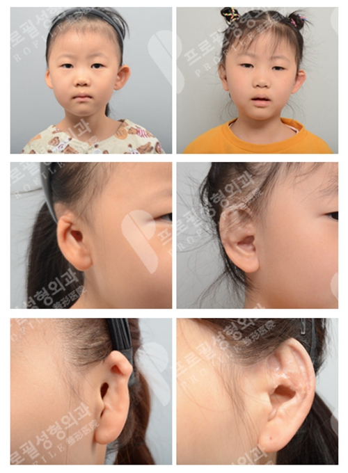 韩国普罗菲耳profile医院耳部再造术案例