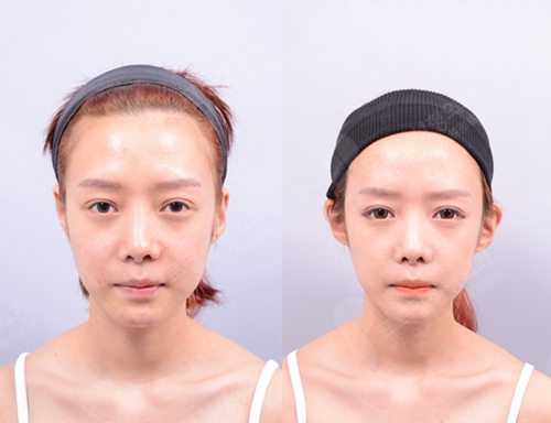 韩国profile普罗菲耳整形医院贴发耳矫正手术