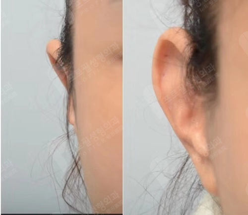 韩国profile普罗菲耳整形医院贴发耳矫正手术案例