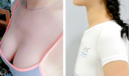 韩国普罗菲耳profile隆胸案例