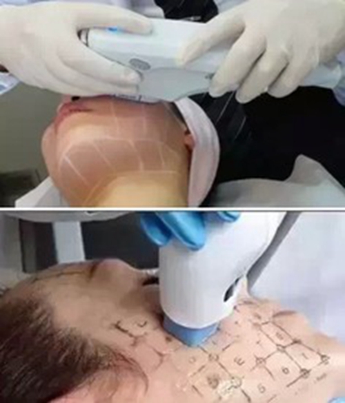 韩国profile普罗菲耳医院热玛吉皮肤管理