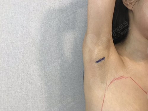 韩国profile普罗菲耳整形医院假体隆胸腋下切口