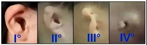 profile普罗菲耳耳畸形程度分类