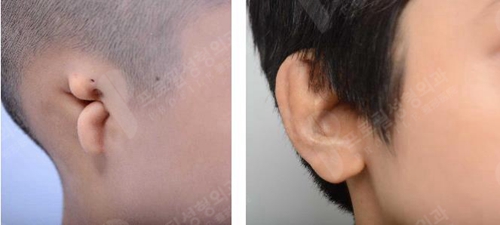 韩国profile普罗菲耳整形医院耳畸形案例