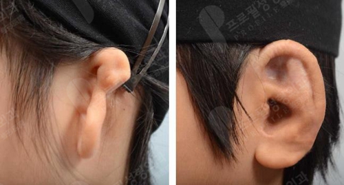 韩国profile普罗菲耳整形医院耳畸形案例