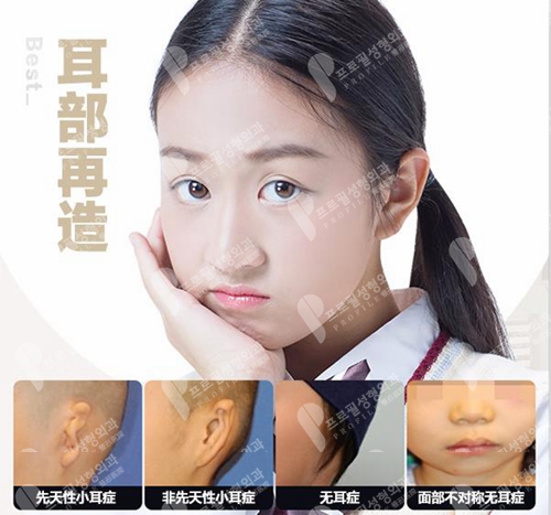 韩国profile普罗菲耳整形医院耳部再造术