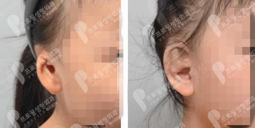 韩国profile普罗菲耳整形医院小女孩耳畸形矫正案例