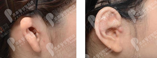 韩国profile普罗菲耳整形医院人工骨耳畸形矫正案例