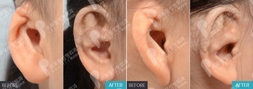 韩国profile普罗菲耳整形医院耳部畸形矫正案例
