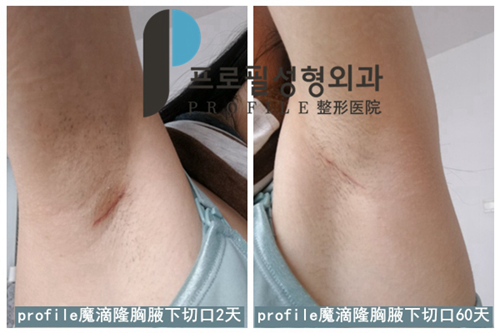 韩国profile普罗菲耳医院假体隆胸疤痕
