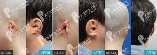 韩国profile普罗菲耳整形医院先天性小耳畸形矫正案例