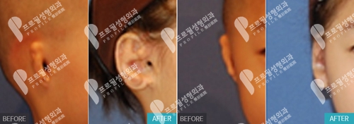 韩国profile普罗菲耳整形医院先天性部畸形人工骨矫正案例