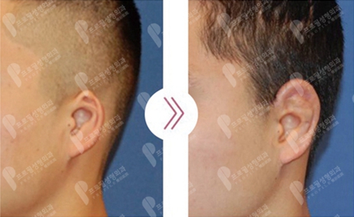 韩国profile普罗菲耳整形医院外耳廓畸形矫正案例