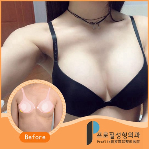 韩国profile普罗菲耳医院隆胸案例