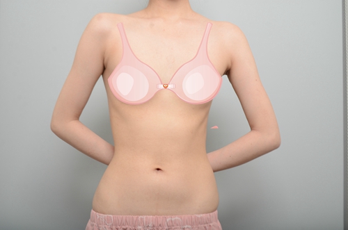 韩国profile普罗菲耳整形医院假体隆胸术前