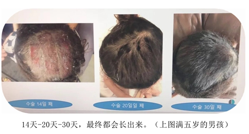 韩国profile普罗菲耳整形医院而不皮肤移植供皮区疤痕恢复