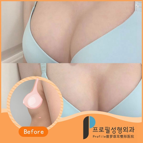 韩国profile普罗菲耳医院隆胸案例