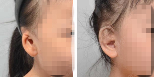 profile小耳畸形案例对比