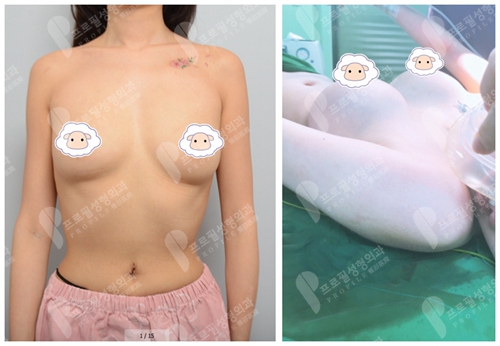 韩国profile医院郑在皓院长动感假体隆胸案例术后即刻