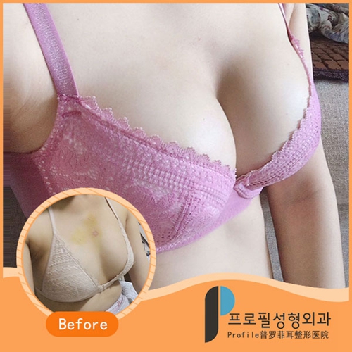 韩国profile普罗菲耳整形医院假体隆胸修复案例