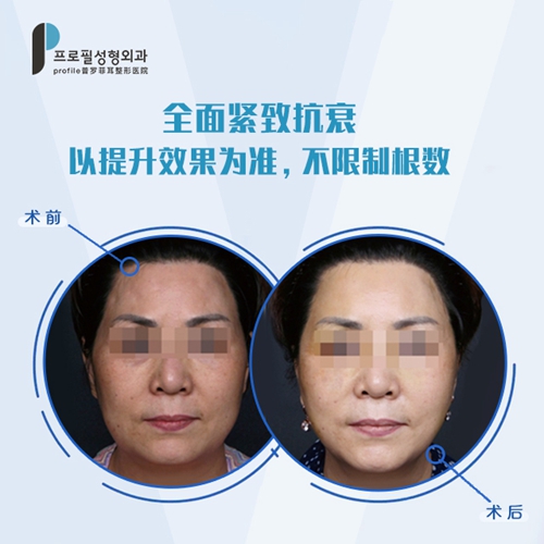 韩国profile普罗菲耳整形医院下颌缘小切口三重提升术改善