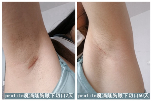 韩国普罗菲耳profile整形医院郑在皓院长假体隆胸术后2-60天疤痕