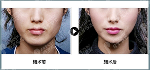 小切口三重提升术改善下颌缘重塑V脸型案例