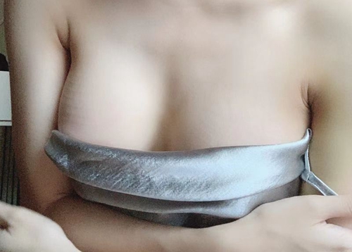 韩国profile普罗菲耳整形医院假体隆胸术后