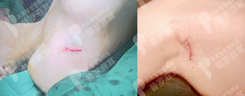 韩国profile普罗菲耳医院隆胸术后即刻腋下切口