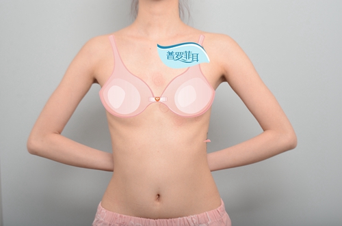 韩国profile普罗菲耳整形外科蓓拉假体隆胸术前